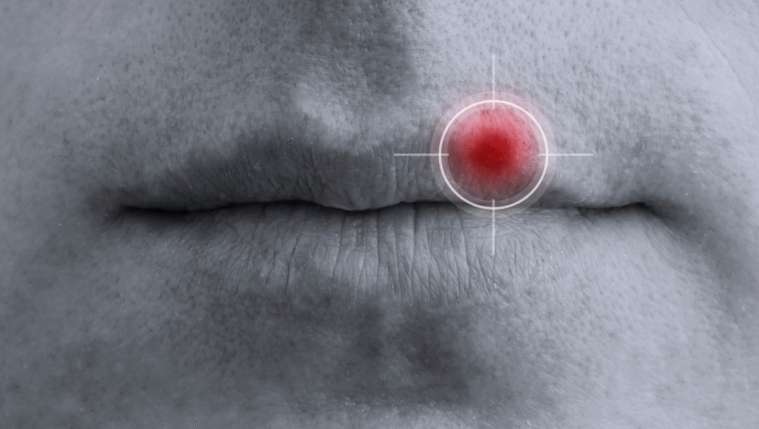 Herpes: Sve što treba da znate o simptomima, prenošenju, lečenju i prevenciji