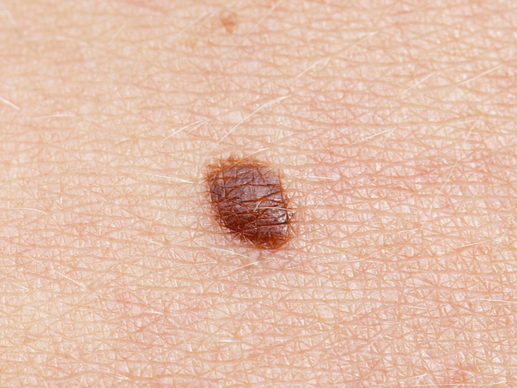 Kako izgleda rak kože: Vodič za rano prepoznavanje