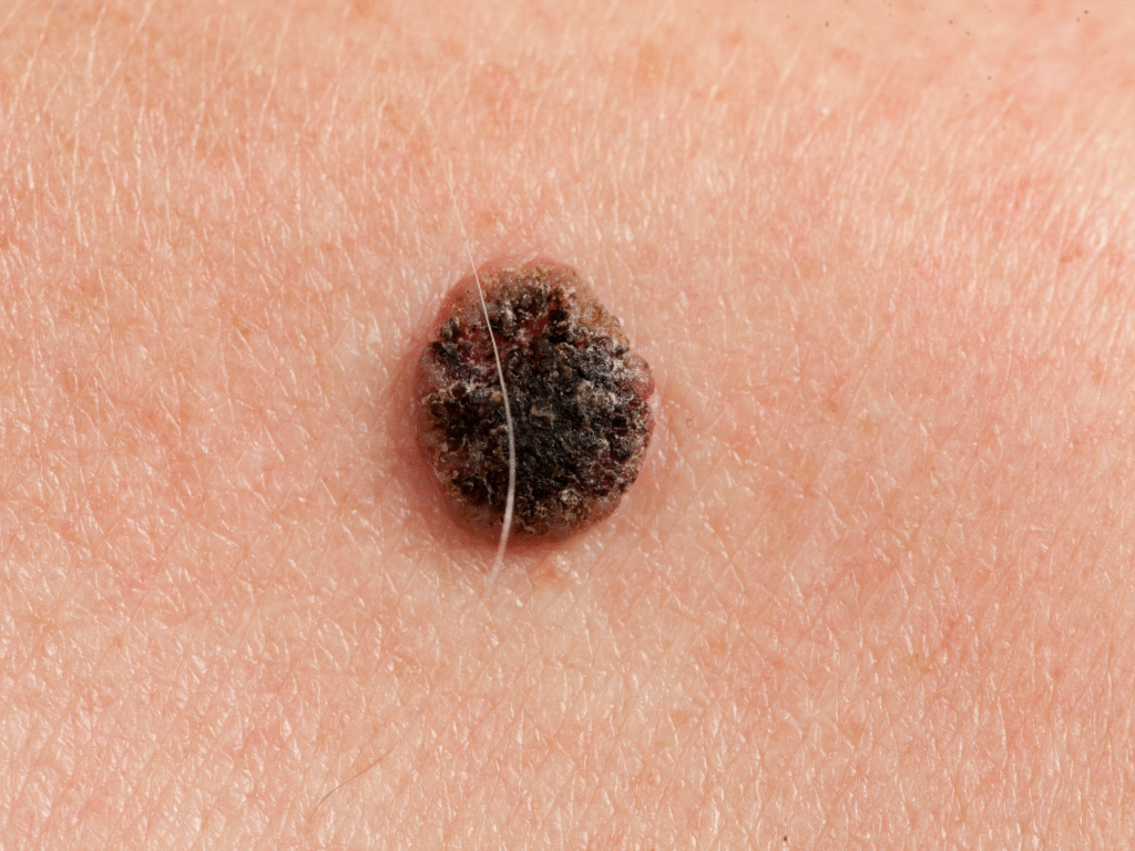 Kako izgleda rak kože: Vodič za rano prepoznavanje