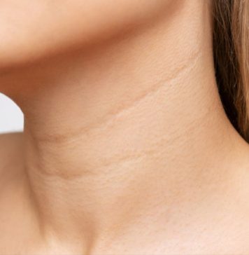 Bore na vratu sprečite uz 4 najdelotvornija sastojka za negu kože