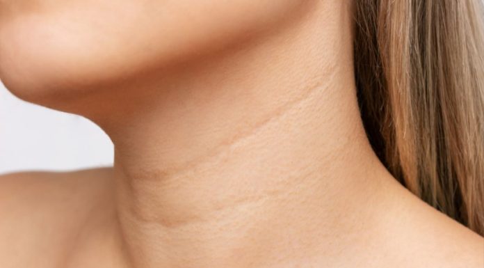 Bore na vratu sprečite uz 4 najdelotvornija sastojka za negu kože