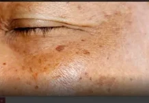 “Tamne mrlje nestaju uz ovu prirodnu smjesu – recept koji svaka zena treba znati”