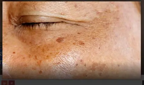 “Tamne mrlje nestaju uz ovu prirodnu smjesu – recept koji svaka zena treba znati”