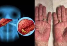 Ako osjetite ovo, odmah se obratite ljekaru! Jeziva bolest napada poslije 40. godine