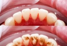 Evo kako sami da skinete kamenac sa zuba. Ove jeftine sastojke već imate kod kuće! (FOTO) Evo kako sami da skinete kamenac sa zuba. Ove jeftine sastojke već imate kod kuće! (FOTO) - featured image