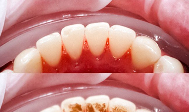Evo kako sami da skinete kamenac sa zuba. Ove jeftine sastojke već imate kod kuće! (FOTO) Evo kako sami da skinete kamenac sa zuba. Ove jeftine sastojke već imate kod kuće! (FOTO) - featured image