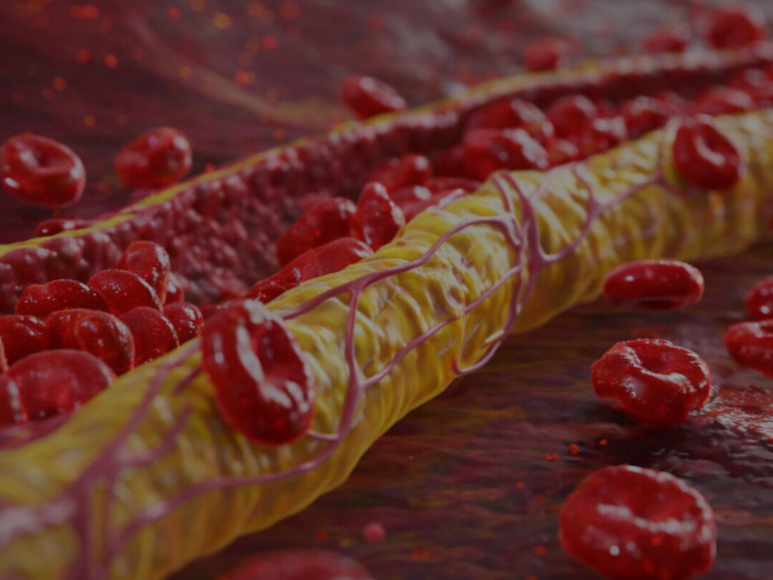 Ovi znaci na nogama pokazuju da imate izuzetno visok holesterol: Ne smijete ih ignorisati, posljedice su fatalne po tijelo - featured image Ovi znaci na nogama pokazuju da imate izuzetno visok holesterol: Ne smijete ih ignorisati, posljedice su fatalne po tijelo - featured image