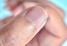 Ako imate ove linije na noktima nakon 40. godine, to je jasan znak da… Ako imate ove linije na noktima nakon 40. godine, to je jasan znak da… - featured image