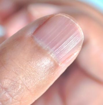 Ako imate ove linije na noktima nakon 40. godine, to je jasan znak da… Ako imate ove linije na noktima nakon 40. godine, to je jasan znak da… - featured image