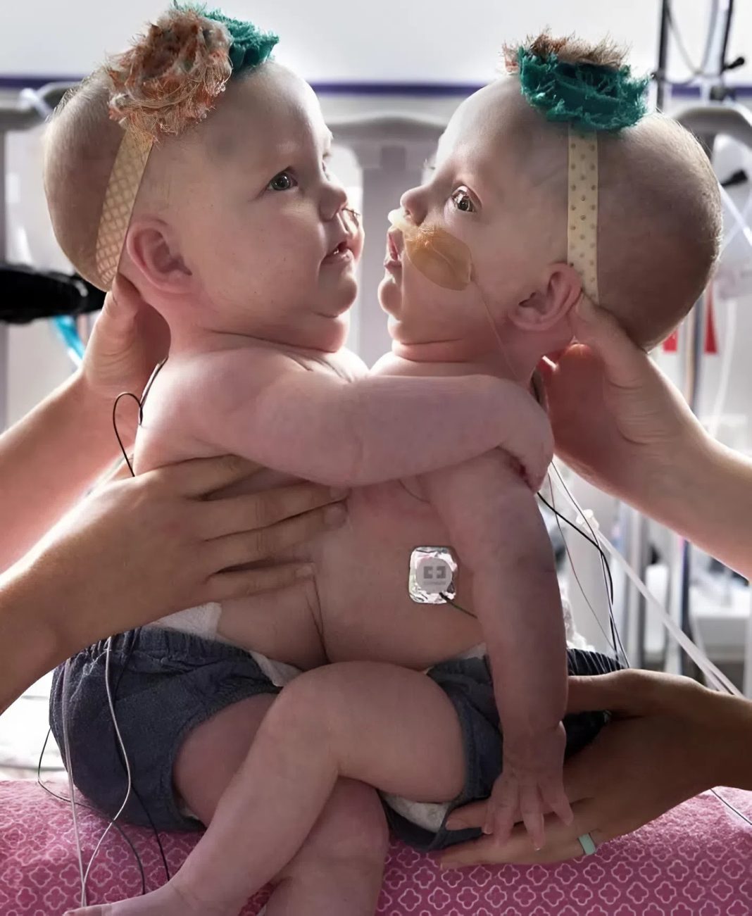 Ove povezane sestre su rođene spojene na grudima i stomaku 😱 Zbog ove povezanosti, imale su poteškoće da sede, okrenu se ili čak leže udobno 😢 - featured image