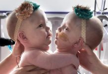 Ove povezane sestre su rođene spojene na grudima i stomaku 😱 Zbog ove povezanosti, imale su poteškoće da sede, okrenu se ili čak leže udobno 😢 Ove povezane sestre su rođene spojene na grudima i stomaku 😱 Zbog ove povezanosti, imale su poteškoće da sede, okrenu se ili čak leže udobno 😢 - featured image