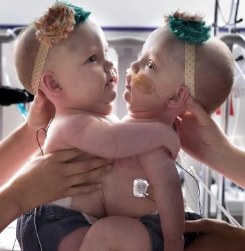 Ove povezane sestre su rođene spojene na grudima i stomaku 😱 Zbog ove povezanosti, imale su poteškoće da sede, okrenu se ili čak leže udobno 😢 Ove povezane sestre su rođene spojene na grudima i stomaku 😱 Zbog ove povezanosti, imale su poteškoće da sede, okrenu se ili čak leže udobno 😢 - featured image