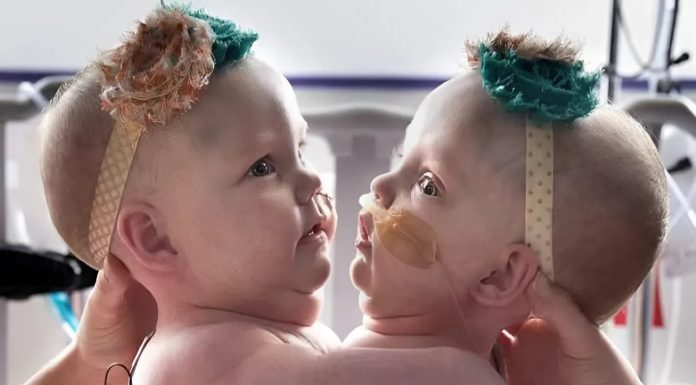 Ove povezane sestre su rođene spojene na grudima i stomaku 😱 Zbog ove povezanosti, imale su poteškoće da sede, okrenu se ili čak leže udobno 😢 Ove povezane sestre su rođene spojene na grudima i stomaku 😱 Zbog ove povezanosti, imale su poteškoće da sede, okrenu se ili čak leže udobno 😢 - featured image