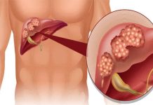 Koji su vidljivi znakovi disfunkcije jetre na koži i nogama? OVO SU ZNAKOVI BOLESTI KOJA POGODAVA JETRU…PRESTANITE SE ZEZATI