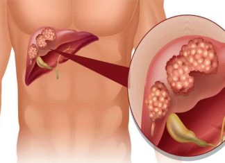 Koji su vidljivi znakovi disfunkcije jetre na koži i nogama? OVO SU ZNAKOVI BOLESTI KOJA POGODAVA JETRU…PRESTANITE SE ZEZATI