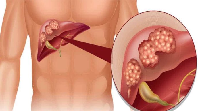 Koji su vidljivi znakovi disfunkcije jetre na koži i nogama? OVO SU ZNAKOVI BOLESTI KOJA POGODAVA JETRU…PRESTANITE SE ZEZATI