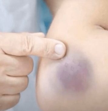 NIKAD NE BISTE POGODILI ZAŠTO SE MODRICE JAVLJAJU PO TIJELU: Nema veze sa POVREDAMA, PRAVI RAZLOGĆE VAS ŠOKIRATI NIKAD NE BISTE POGODILI ZAŠTO SE MODRICE JAVLJAJU PO TIJELU: Nema veze sa POVREDAMA, PRAVI RAZLOGĆE VAS ŠOKIRATI - featured image