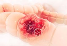 RAK DEBELOG CREVA ŠALJE OVIH 7 SIGNALA: 90% ljudi neće obratiti pažnju na ove znake, ali to može da im spase život RAK DEBELOG CREVA ŠALJE OVIH 7 SIGNALA: 90% ljudi neće obratiti pažnju na ove znake, ali to može da im spase život - featured image