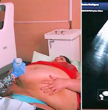 Trudna žena ima 226 kilograma i došla je na ultrazvuk, a onda je medicinska sestra podigla njen stomak i pogledala bolje… (VIDEO) Trudna žena ima 226 kilograma i došla je na ultrazvuk, a onda je medicinska sestra podigla njen stomak i pogledala bolje… (VIDEO) - featured image