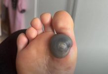 Velika modrica ili krvni žulj na stopalu kod deteta: uzroci, simptomi i kako postupiti Velika modrica ili krvni žulj na stopalu kod deteta: uzroci, simptomi i kako postupiti - featured image