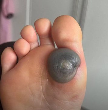 Velika modrica ili krvni žulj na stopalu kod deteta: uzroci, simptomi i kako postupiti Velika modrica ili krvni žulj na stopalu kod deteta: uzroci, simptomi i kako postupiti - featured image