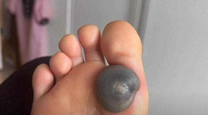 Velika modrica ili krvni žulj na stopalu kod deteta: uzroci, simptomi i kako postupiti Velika modrica ili krvni žulj na stopalu kod deteta: uzroci, simptomi i kako postupiti - featured image
