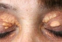 STAVILA SAM OVU NAMIRNICU NA MASNO TKIVO KOD OKA, ono je preko noći nestalo: EVO ŠTA ME SPASILO, SVI GA IMATE U KUĆI STAVILA SAM OVU NAMIRNICU NA MASNO TKIVO KOD OKA, ono je preko noći nestalo: EVO ŠTA ME SPASILO, SVI GA IMATE U KUĆI - featured image