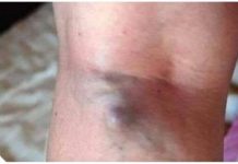 NAMIRNICE KOJE POVEĆAVAJU RIZIK OD TROMBOZE, JEDNA POSEBNO: Jedemo ih svakoga dana, a štete arterijama NAMIRNICE KOJE POVEĆAVAJU RIZIK OD TROMBOZE, JEDNA POSEBNO: Jedemo ih svakoga dana, a štete arterijama - featured image