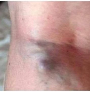 NAMIRNICE KOJE POVEĆAVAJU RIZIK OD TROMBOZE, JEDNA POSEBNO: Jedemo ih svakoga dana, a štete arterijama NAMIRNICE KOJE POVEĆAVAJU RIZIK OD TROMBOZE, JEDNA POSEBNO: Jedemo ih svakoga dana, a štete arterijama - featured image