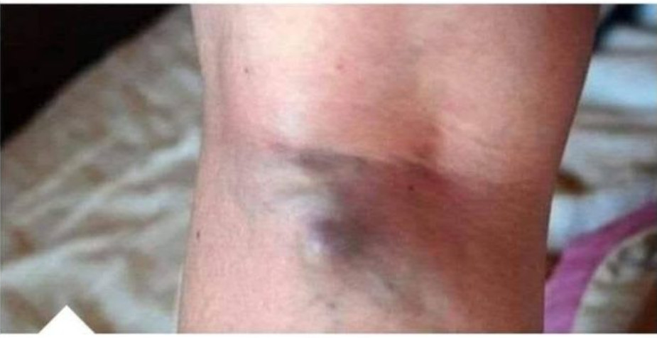 NAMIRNICE KOJE POVEĆAVAJU RIZIK OD TROMBOZE, JEDNA POSEBNO: Jedemo ih svakoga dana, a štete arterijama - featured image NAMIRNICE KOJE POVEĆAVAJU RIZIK OD TROMBOZE, JEDNA POSEBNO: Jedemo ih svakoga dana, a štete arterijama - featured image