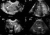 OD RAKA MATERICE UMIRE SVE VEĆI BROJ ŽENA: 6 jasnih signala da se u tijelu razvija ovaj opasan tumor! OD RAKA MATERICE UMIRE SVE VEĆI BROJ ŽENA: 6 jasnih signala da se u tijelu razvija ovaj opasan tumor! - featured image