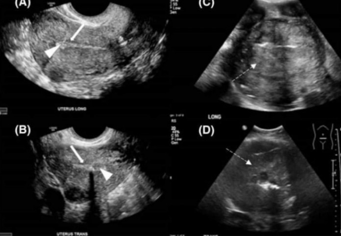 OD RAKA MATERICE UMIRE SVE VEĆI BROJ ŽENA: 6 jasnih signala da se u tijelu razvija ovaj opasan tumor! - featured image OD RAKA MATERICE UMIRE SVE VEĆI BROJ ŽENA: 6 jasnih signala da se u tijelu razvija ovaj opasan tumor! - featured image