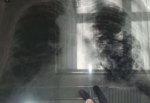 OVO JE PRVI SIMPTOM RAKA PLUĆA, A NIJE KAŠALJ: Većina ljudi ga nikad ne poveže sa ovom opakom bolešću! OVO JE PRVI SIMPTOM RAKA PLUĆA, A NIJE KAŠALJ: Većina ljudi ga nikad ne poveže sa ovom opakom bolešću! - featured image