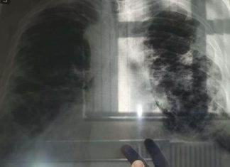 OVO JE PRVI SIMPTOM RAKA PLUĆA, A NIJE KAŠALJ: Većina ljudi ga nikad ne poveže sa ovom opakom bolešću! OVO JE PRVI SIMPTOM RAKA PLUĆA, A NIJE KAŠALJ: Većina ljudi ga nikad ne poveže sa ovom opakom bolešću! - featured image
