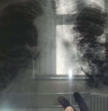 OVO JE PRVI SIMPTOM RAKA PLUĆA, A NIJE KAŠALJ: Većina ljudi ga nikad ne poveže sa ovom opakom bolešću! OVO JE PRVI SIMPTOM RAKA PLUĆA, A NIJE KAŠALJ: Većina ljudi ga nikad ne poveže sa ovom opakom bolešću! - featured image