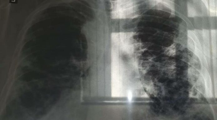 OVO JE PRVI SIMPTOM RAKA PLUĆA, A NIJE KAŠALJ: Većina ljudi ga nikad ne poveže sa ovom opakom bolešću! OVO JE PRVI SIMPTOM RAKA PLUĆA, A NIJE KAŠALJ: Većina ljudi ga nikad ne poveže sa ovom opakom bolešću! - featured image