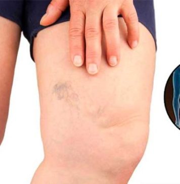 Simptomi krvnih ugrušaka u tijelu: Ako to primijetite, odmah potražite medicinsku pomoć Simptomi krvnih ugrušaka u tijelu: Ako to primijetite, odmah potražite medicinsku pomoć - featured image